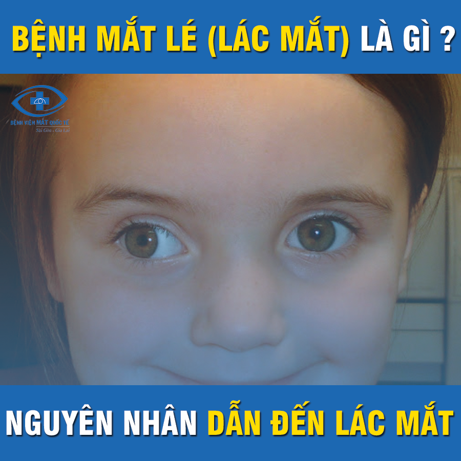 nguyên nhân dẫn đến lác mắt - bệnh viện mắt quốc tế sài gòn gia lai