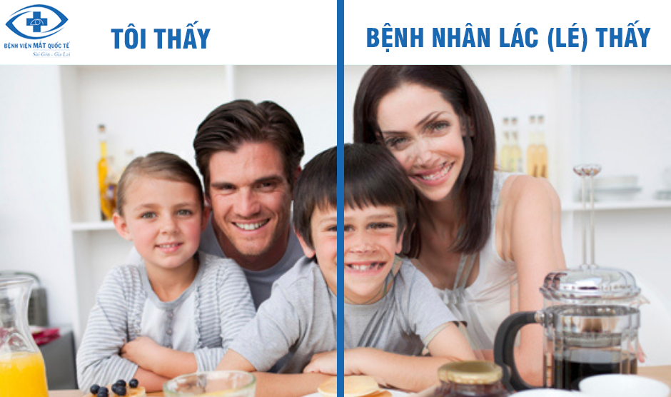 điều trị lác lé