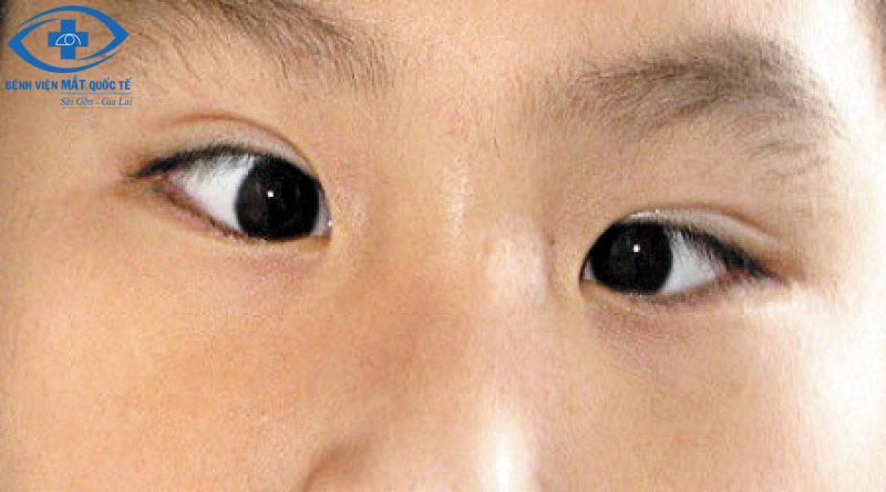 nguyên nhân gây lác mắt - bệnh viện mắt quốc tế sài gòn gia lai