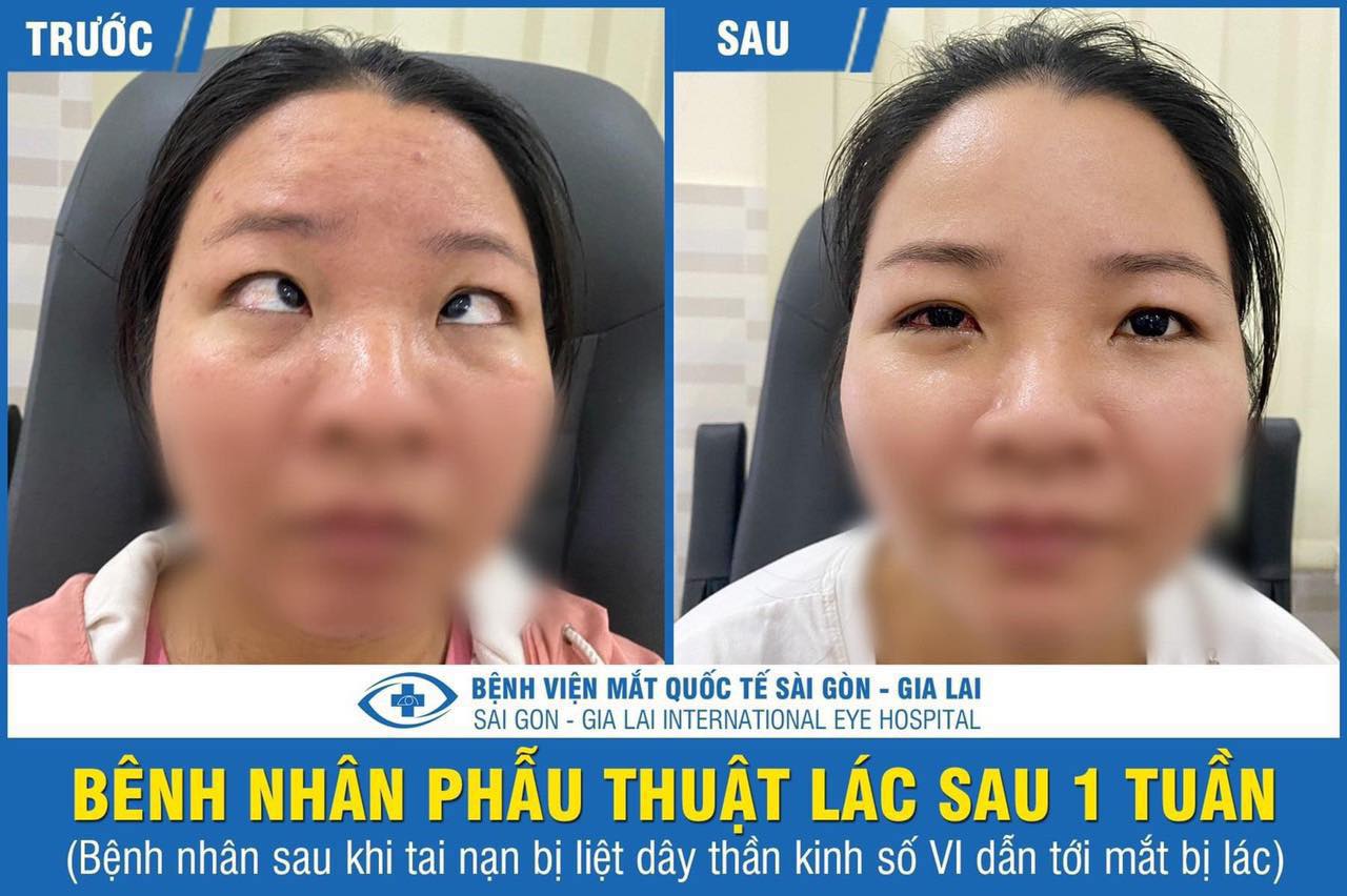 1 bệnh nhân được điều trị lác lé thành công tại bệnh viện mắt quốc tế sài gòn gia lai