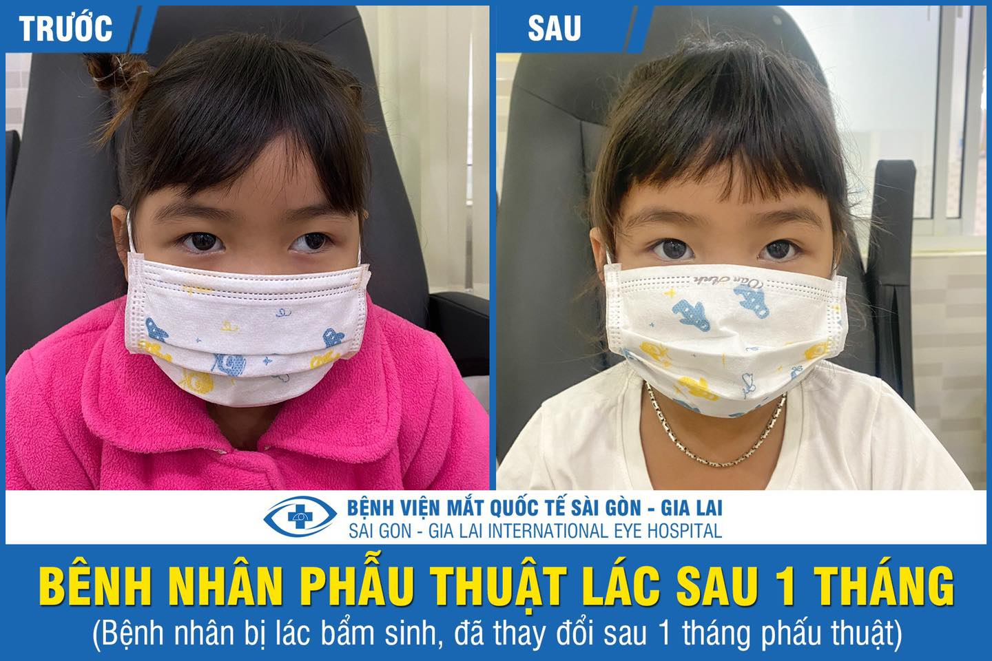 điều trị bệnh lác - lé tại Bệnh viện mắt quốc tế sài gòn gia lai