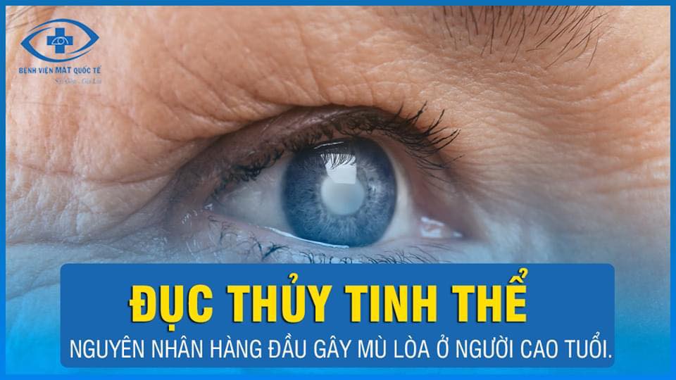 đục thủy tinh thể