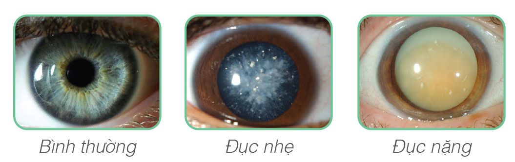 đục thủy tinh thể