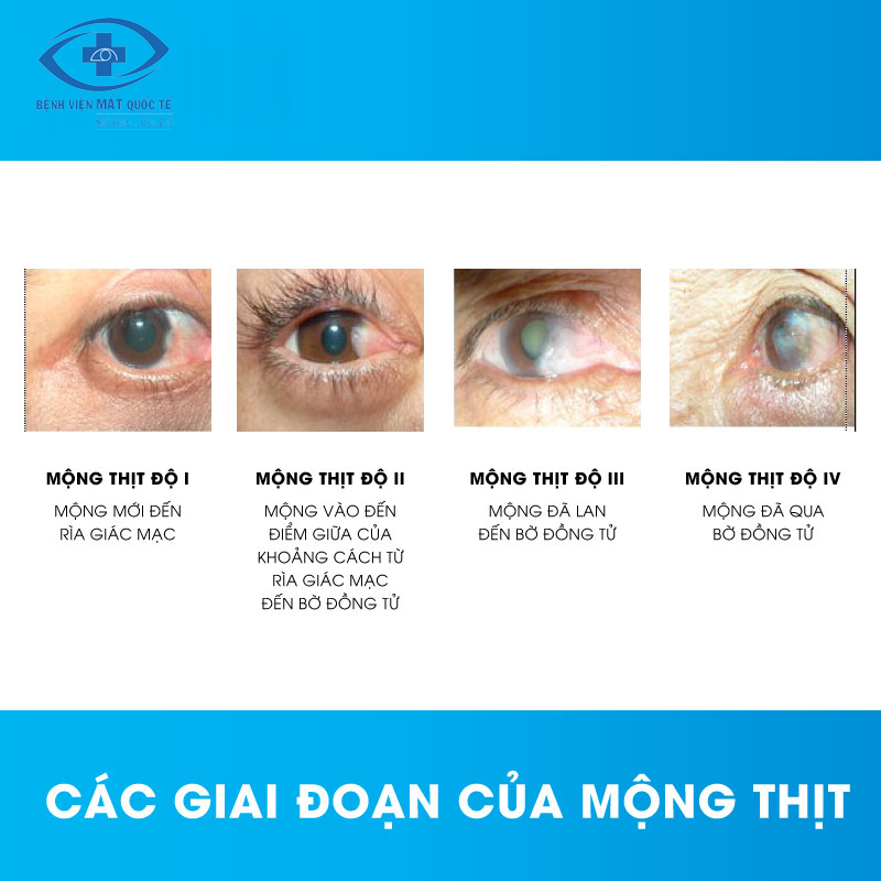 Kiến-thức-nhãn-khoa--Mộng-thịt-03(2)