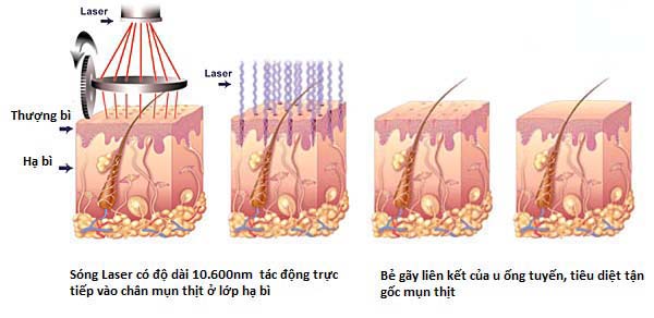 laser-co2-fractional