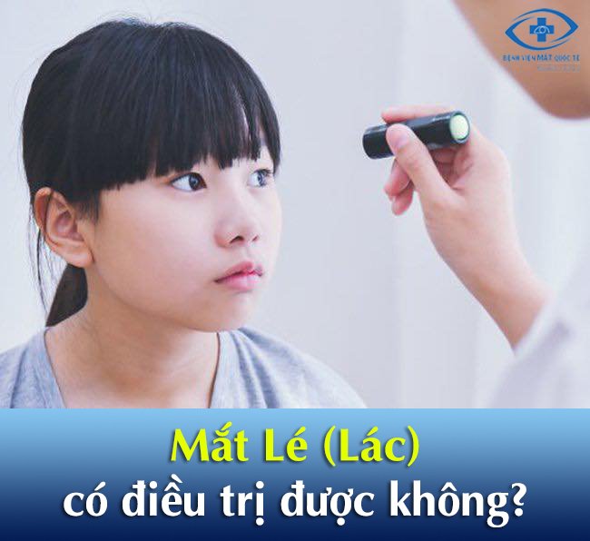 mắt lé có điều trị được không