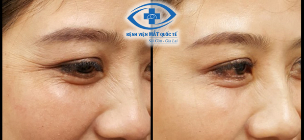 tiêm botox xóa nhăn