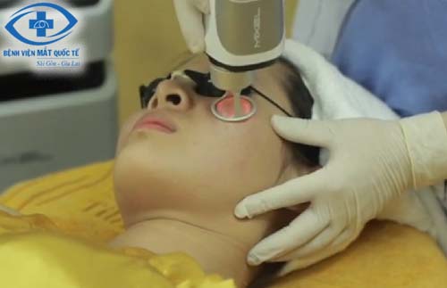 laser-co2-fractional