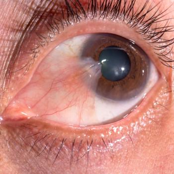 Điều Trị Mộng Mắt (Mộng Thịt)