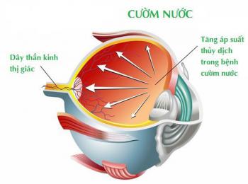 Cườm nước