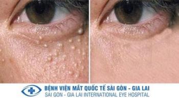 Miễn phí Laser xóa mụn đá, Mụn thịt
