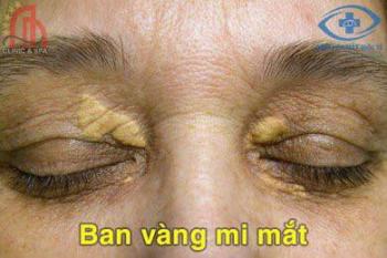 U vàng- U mỡ vàng - Ban vàng mi mắt ( XANTHOMA)