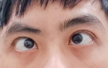 Những câu hỏi thường gặp về bênh lé (lác)