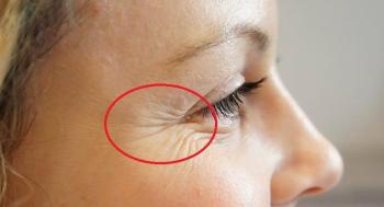 Tiêm Botox xóa nếp nhăn đuôi mắt